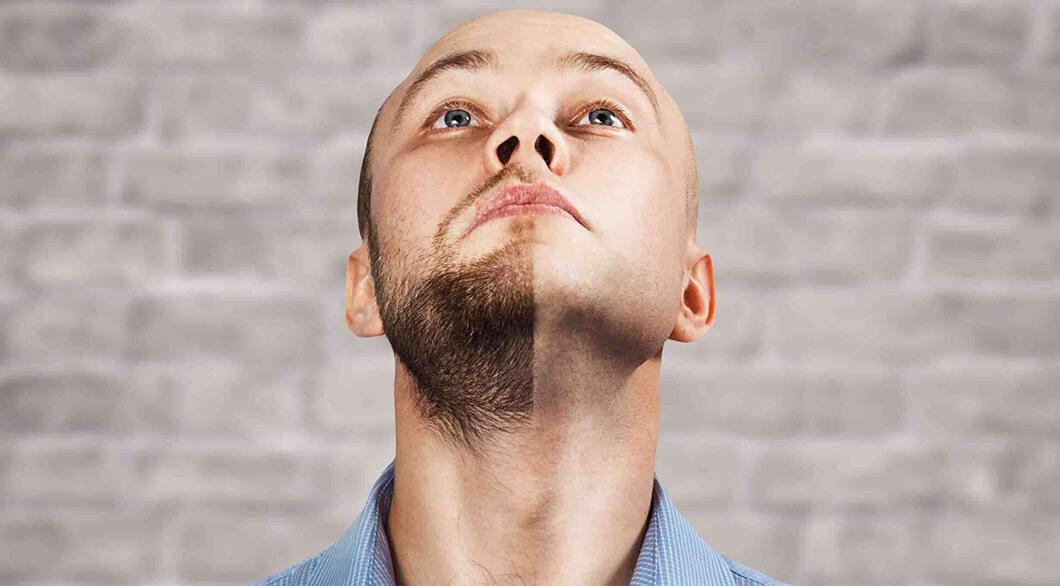 Beard Transplantation