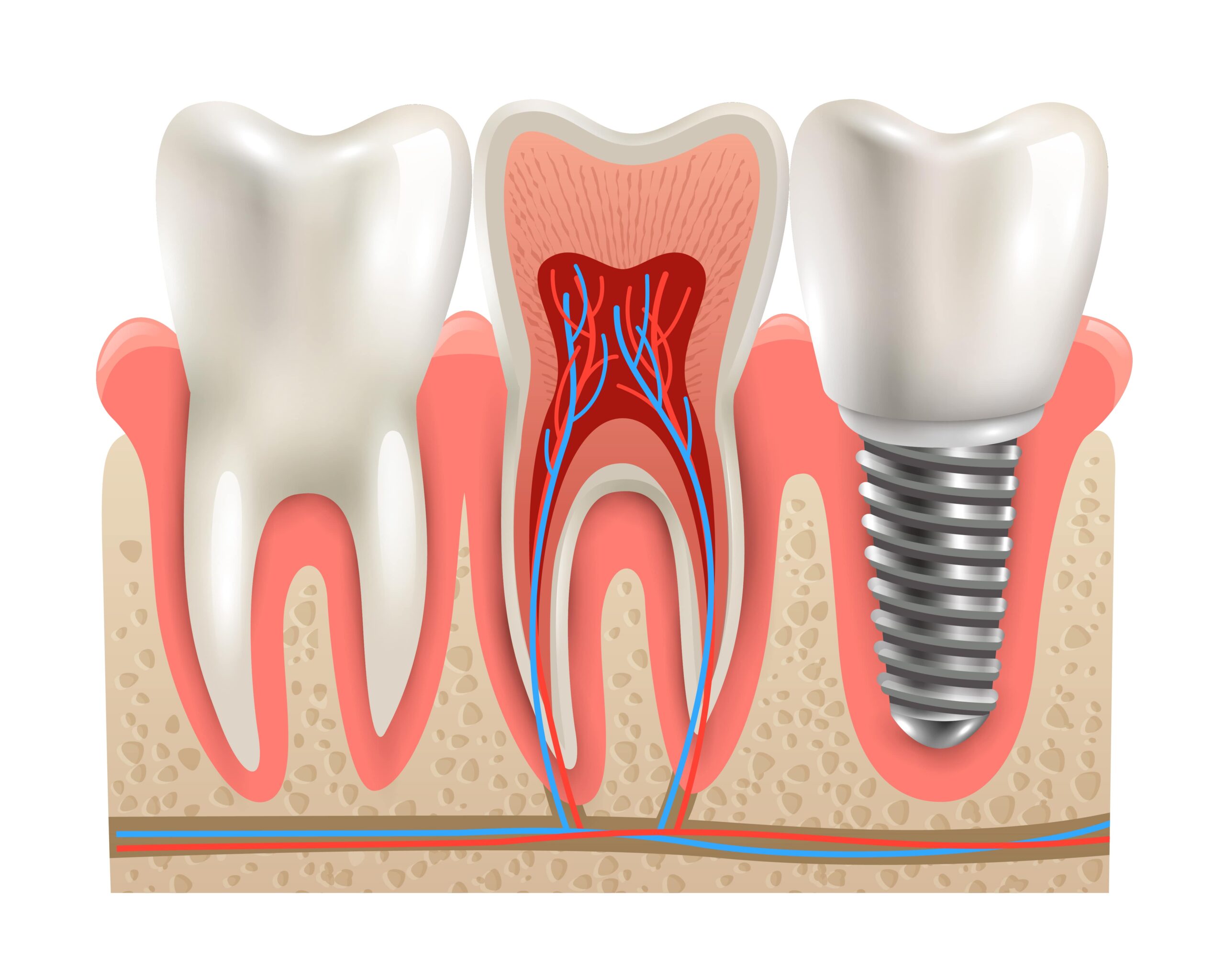 affordable-dental-implant