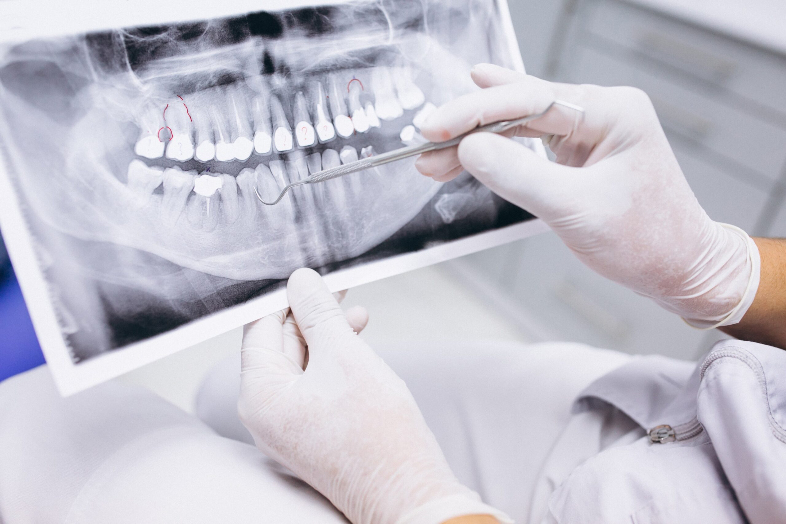 Diş İmplantında Kemik Grefti Nedir?