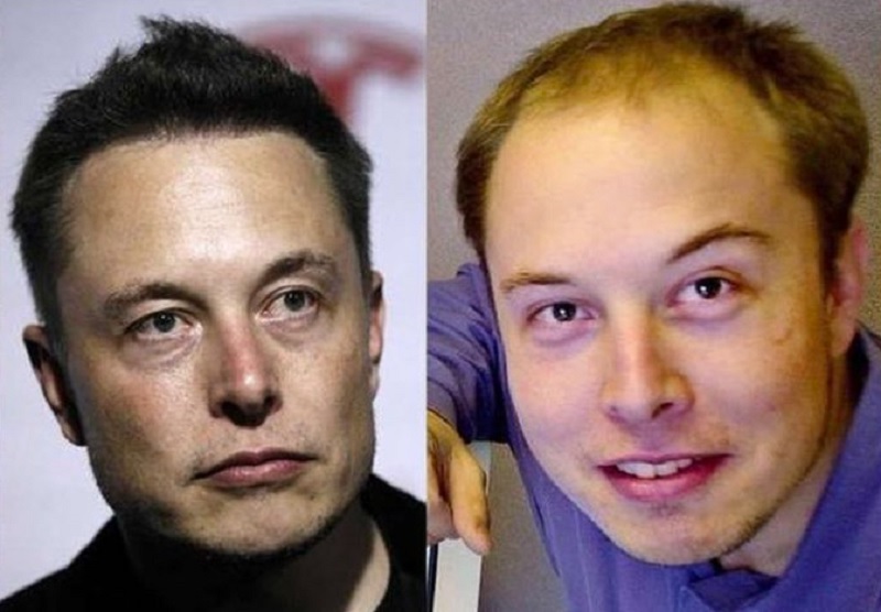 What are Elon Musk Hair Transplant Results?