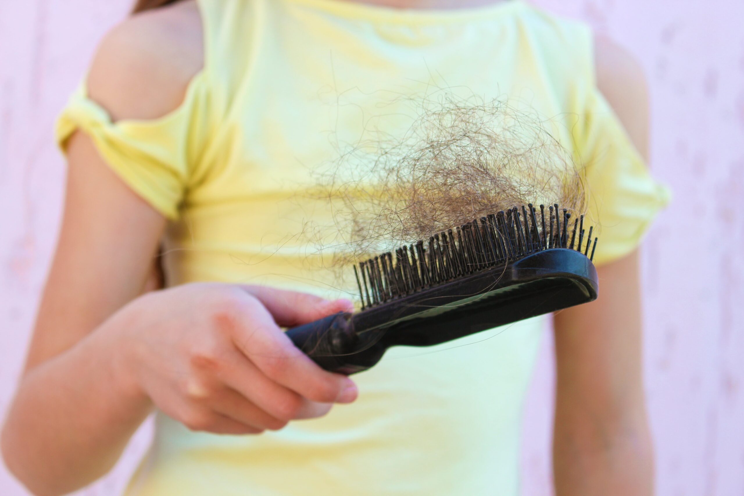 Children with Hairloss Causes and Treatment