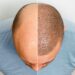hair-transplant-timeline