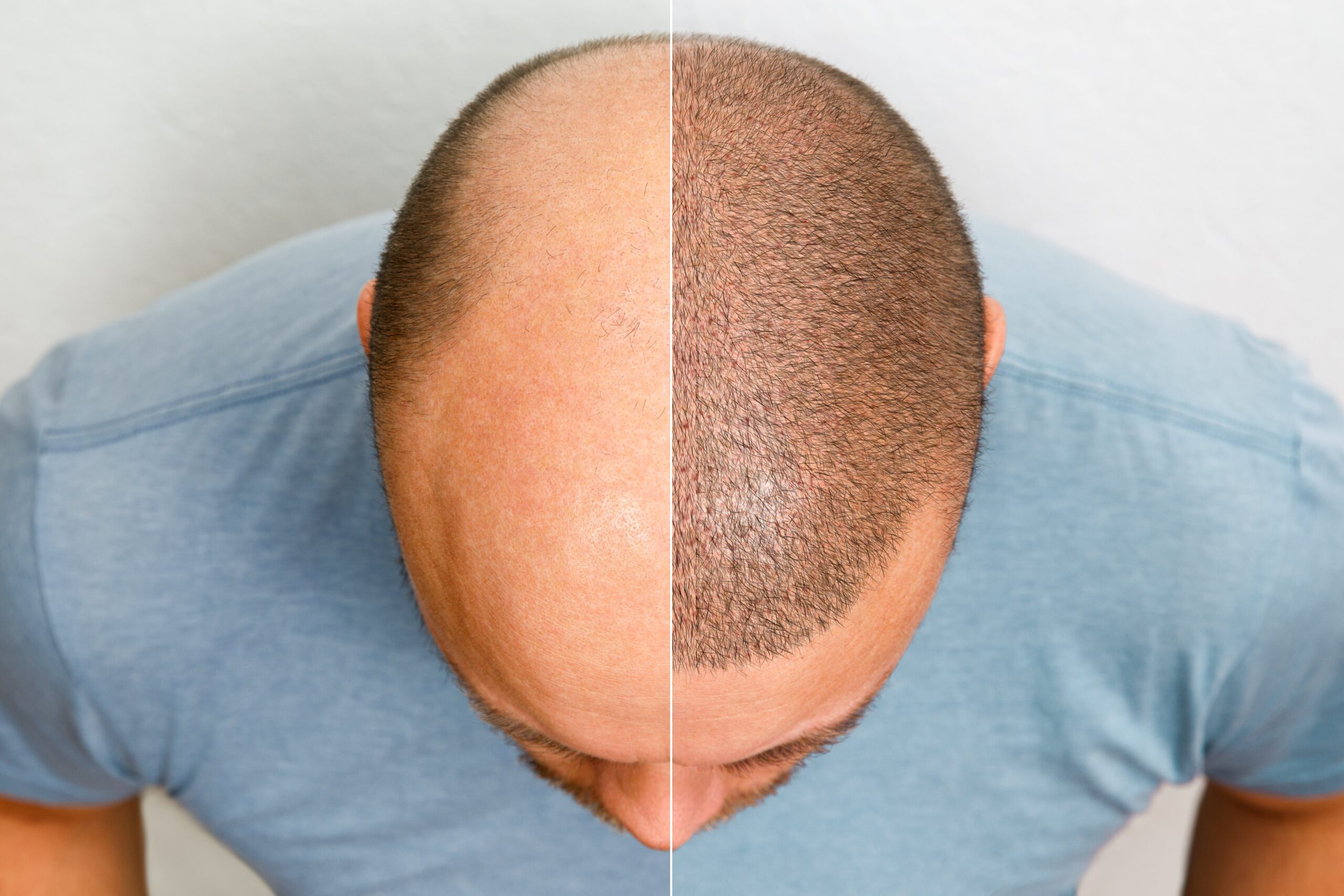 What You Need To Know About Shedding After A Hair Transplant | Treatment  Rooms London
