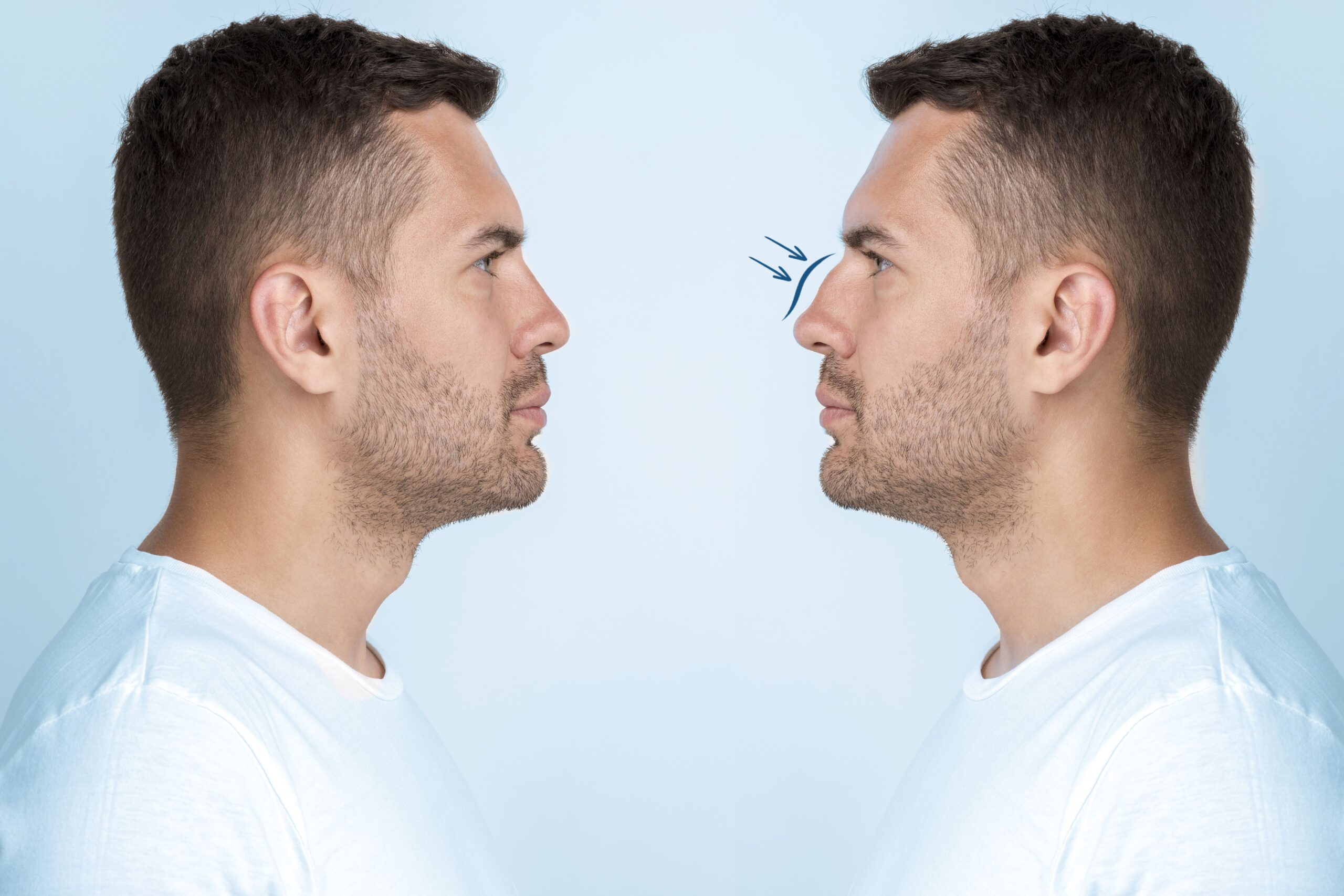 rhinoplasty-swelling-stages