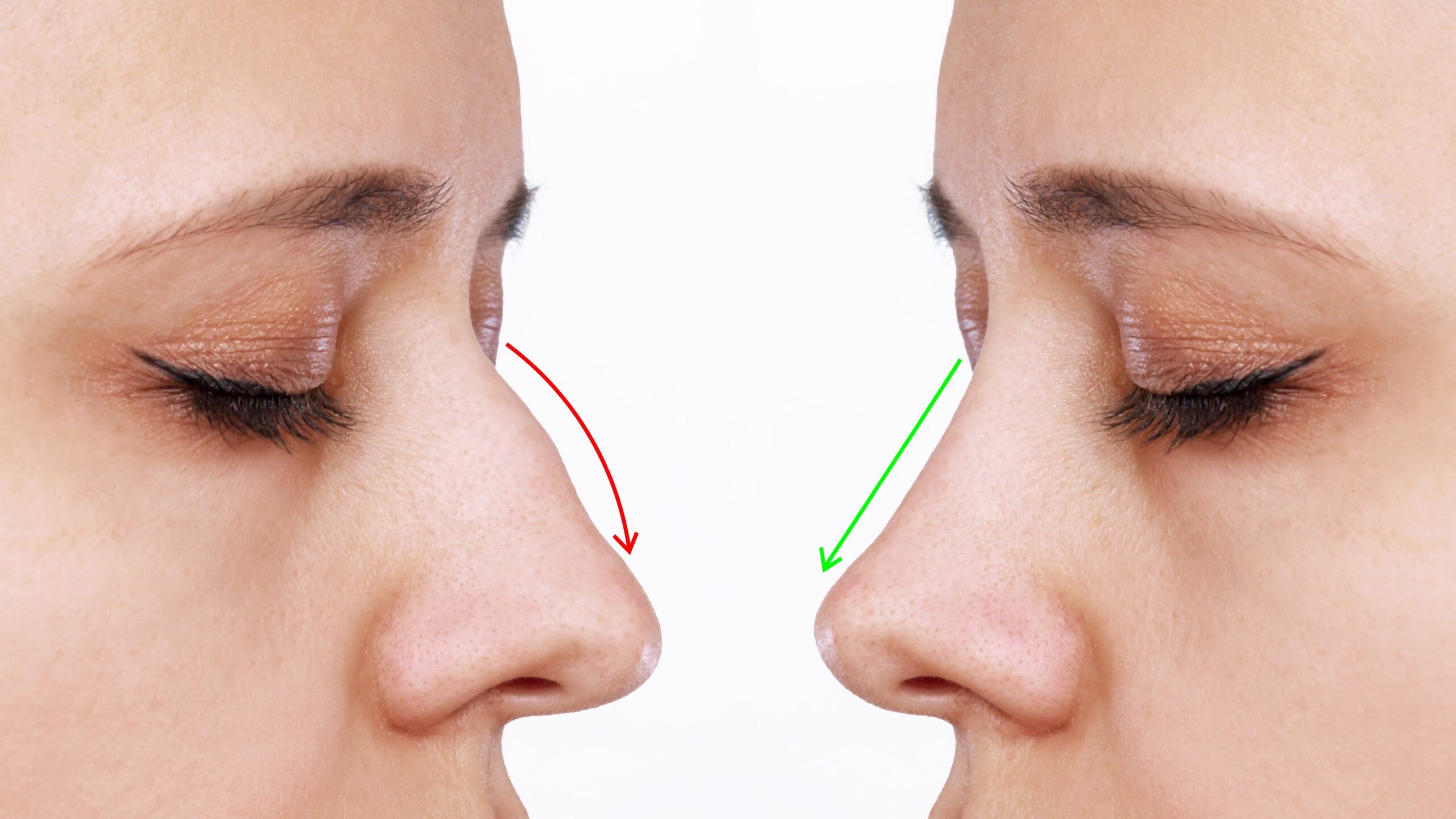 What You Should Know About Rhinoplasty Swelling Stages