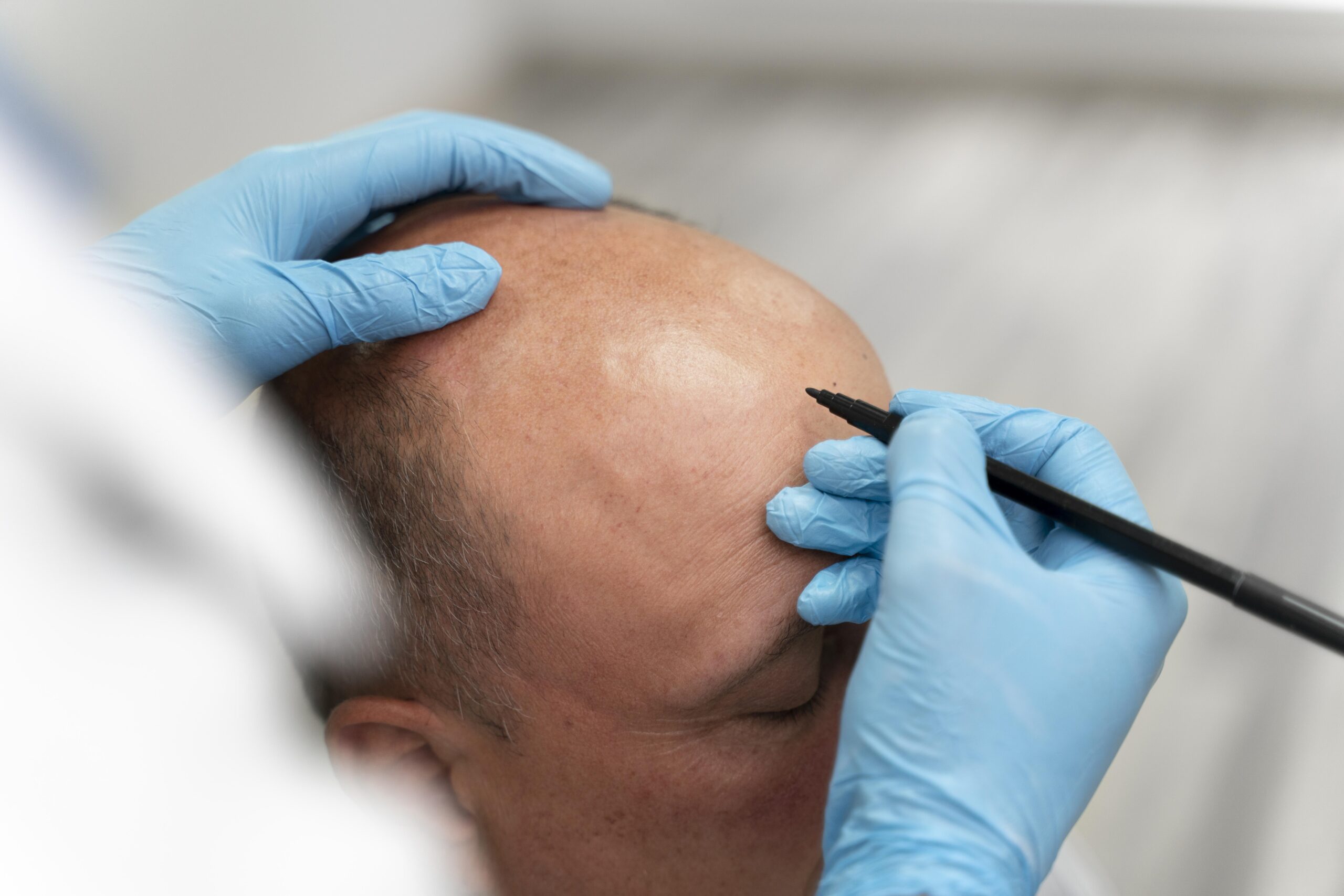 Turkey Hair Transplant Price vs. Other Countries