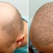 fue-hair-transplant-before-and-after