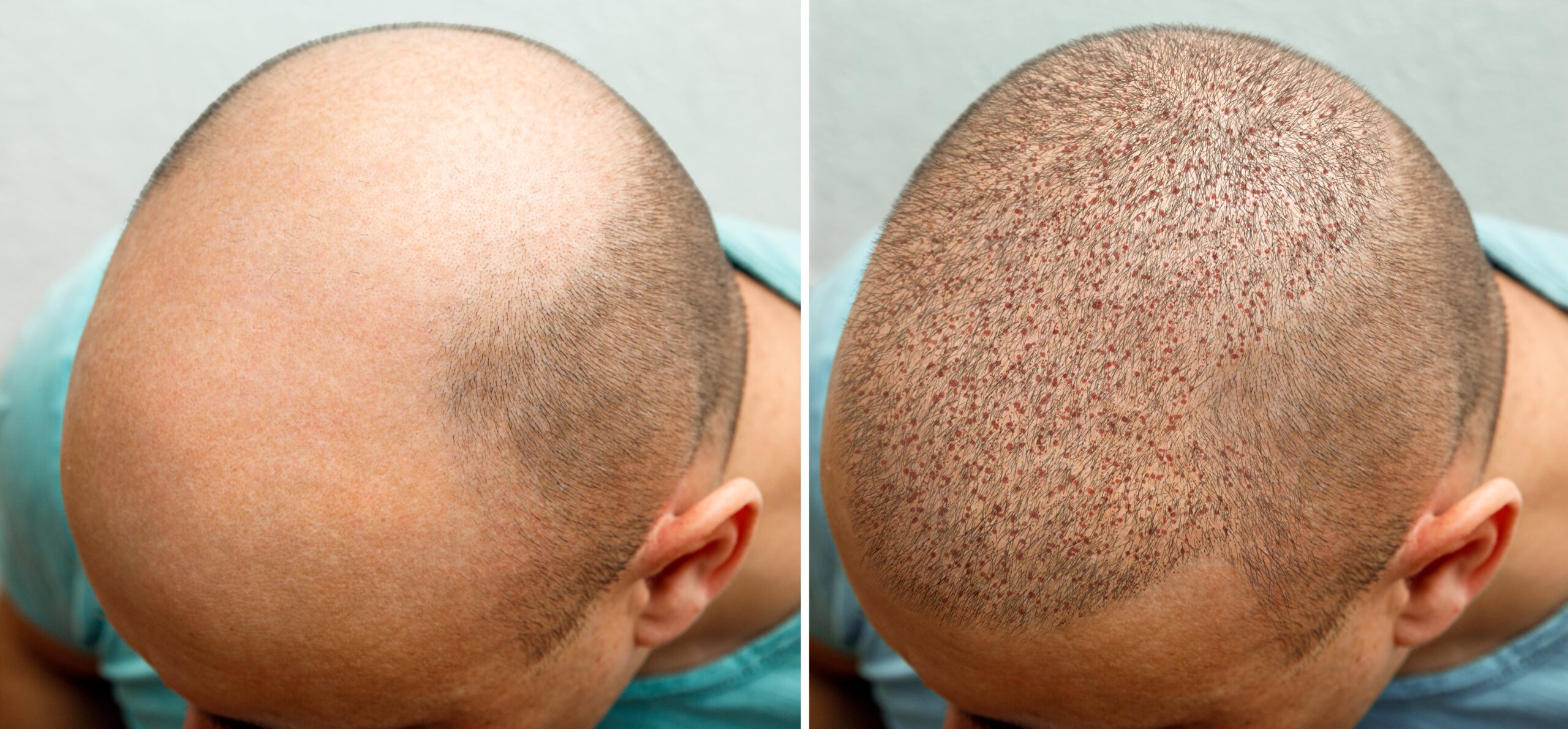 FUE Hair Transplant Before and After Process