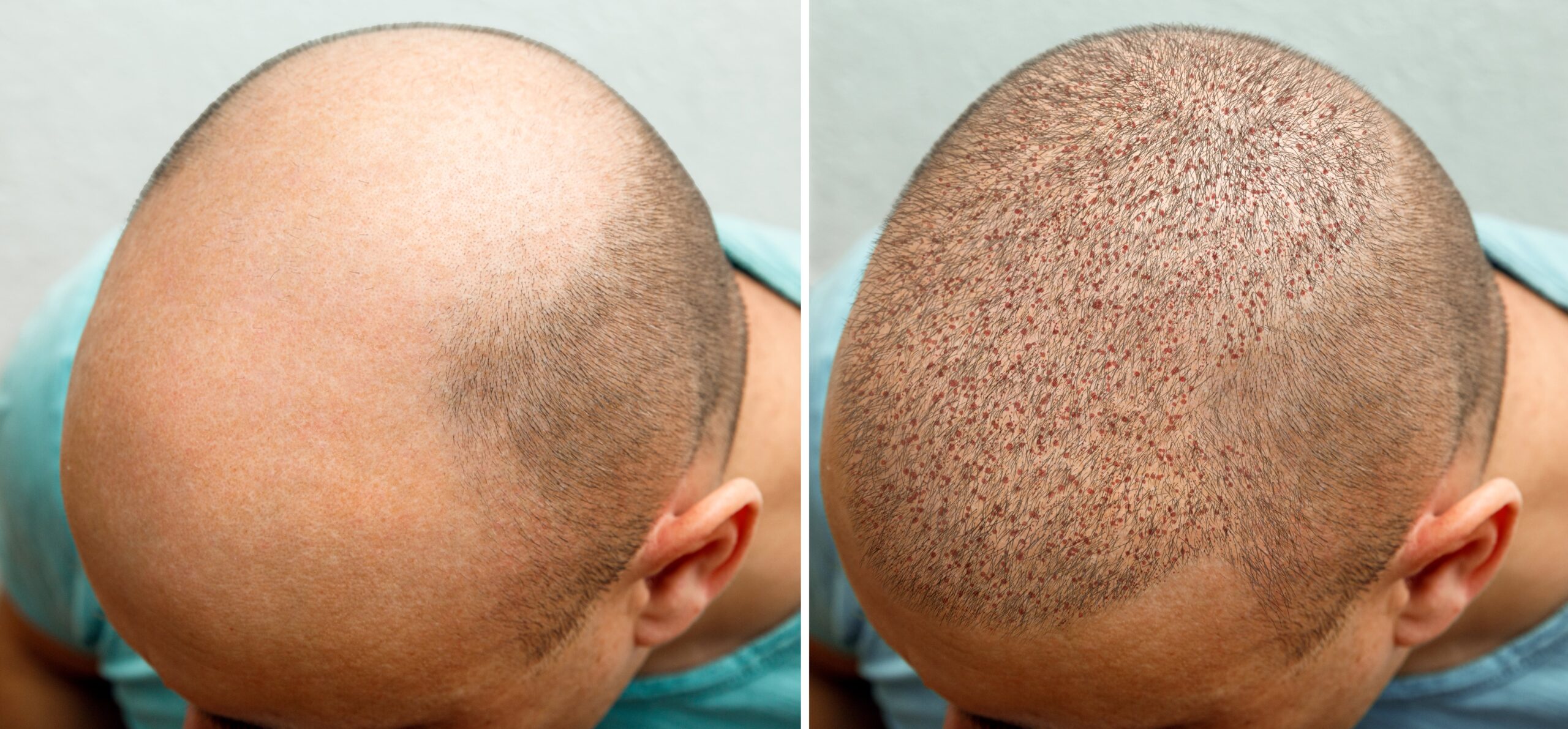 FUE Hair Transplant Before And After Process