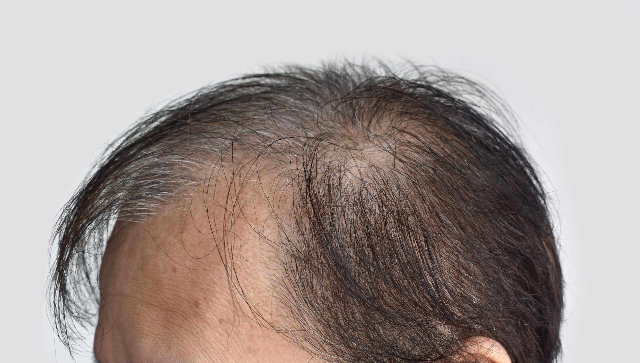 How Much Does Turkey Hair Transplant Cost?