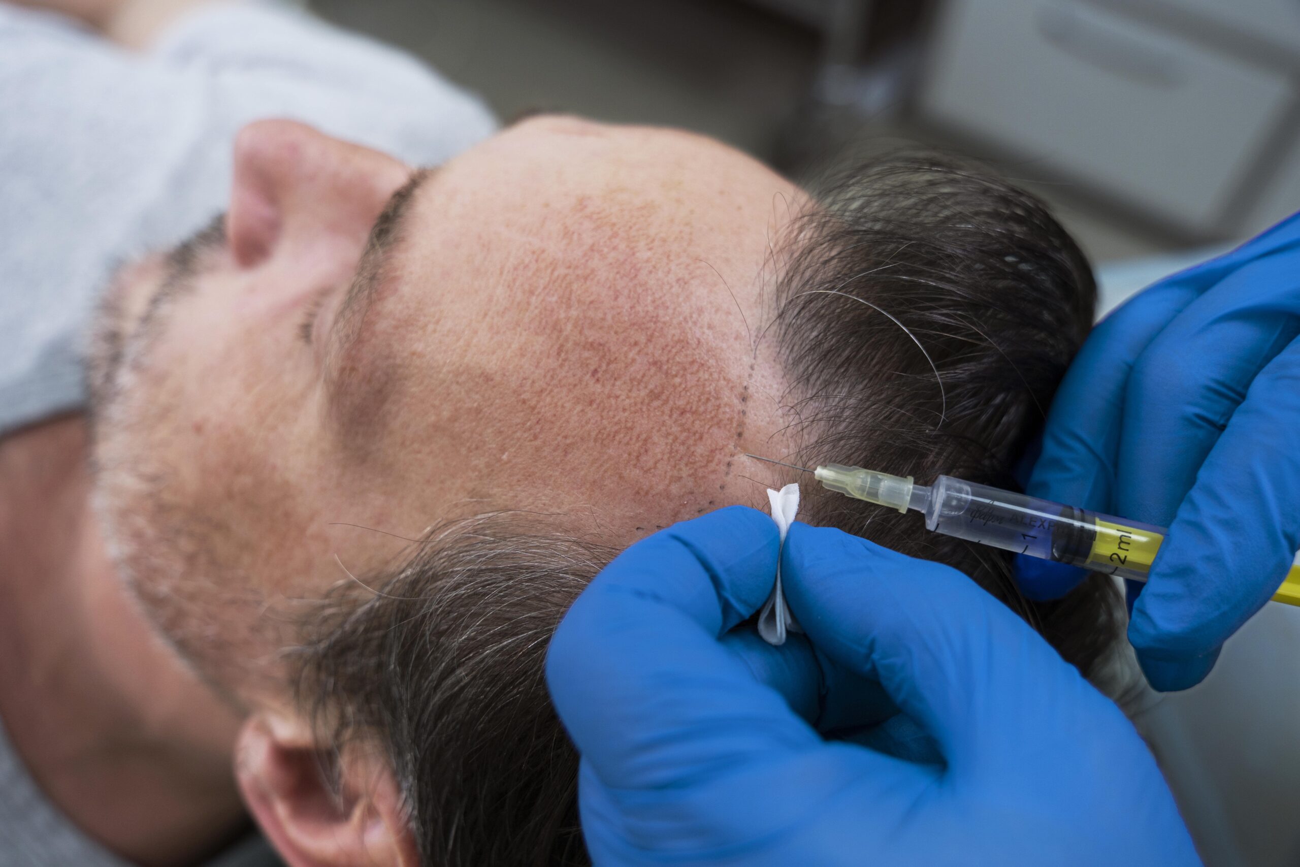 What is Unshaven Hair Transplant? – Is Unshaven Hair Transplant Better?