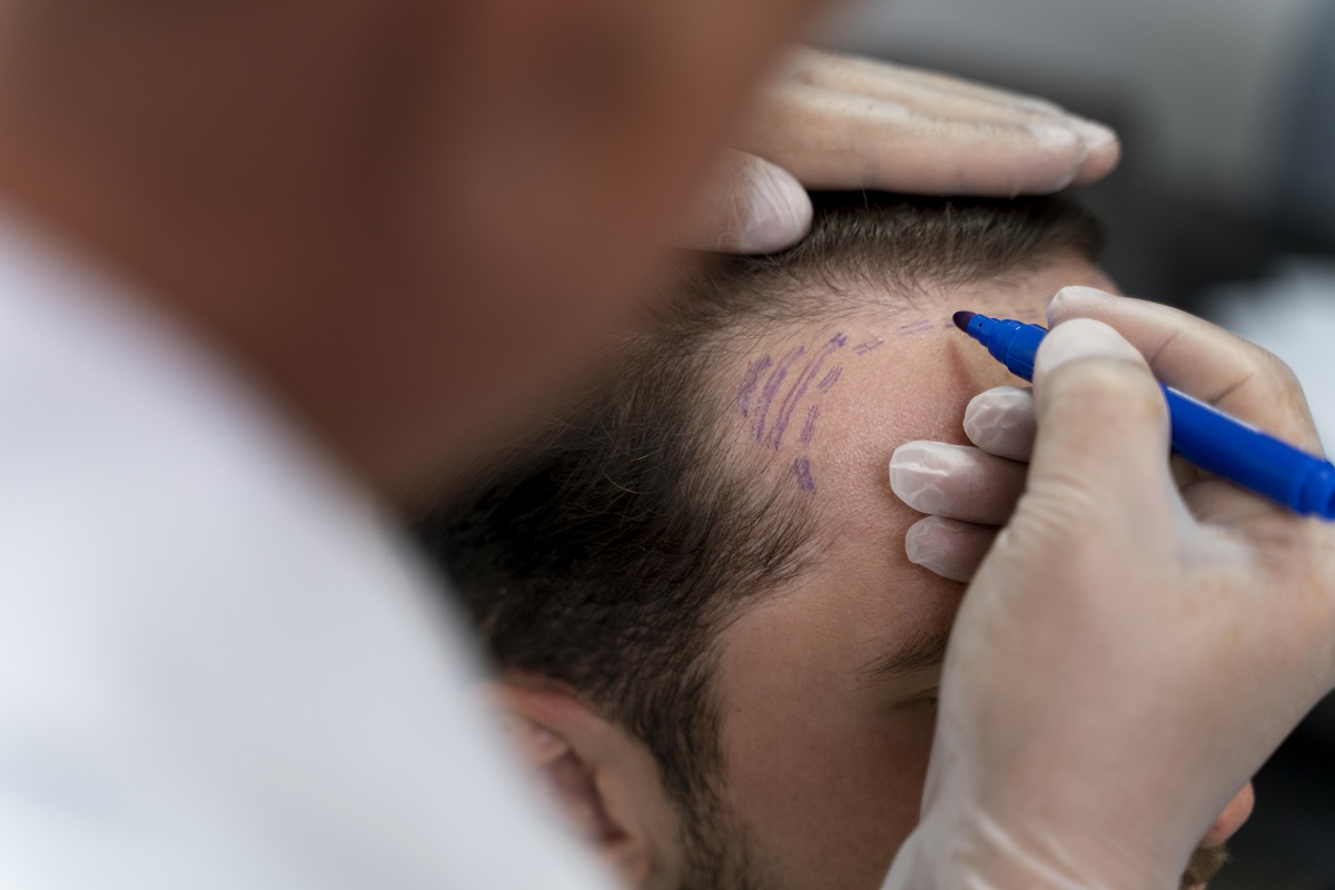 scalp-micropigmentation