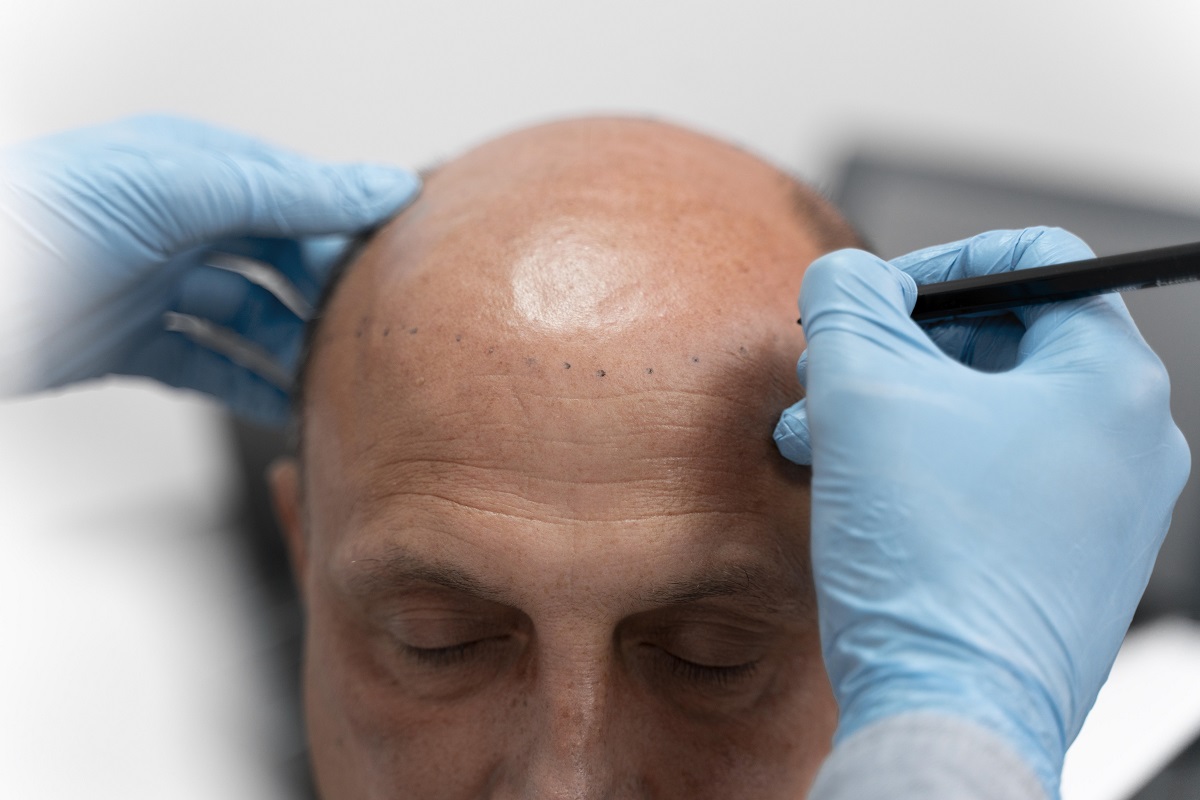 scalp-micropigmentation-4