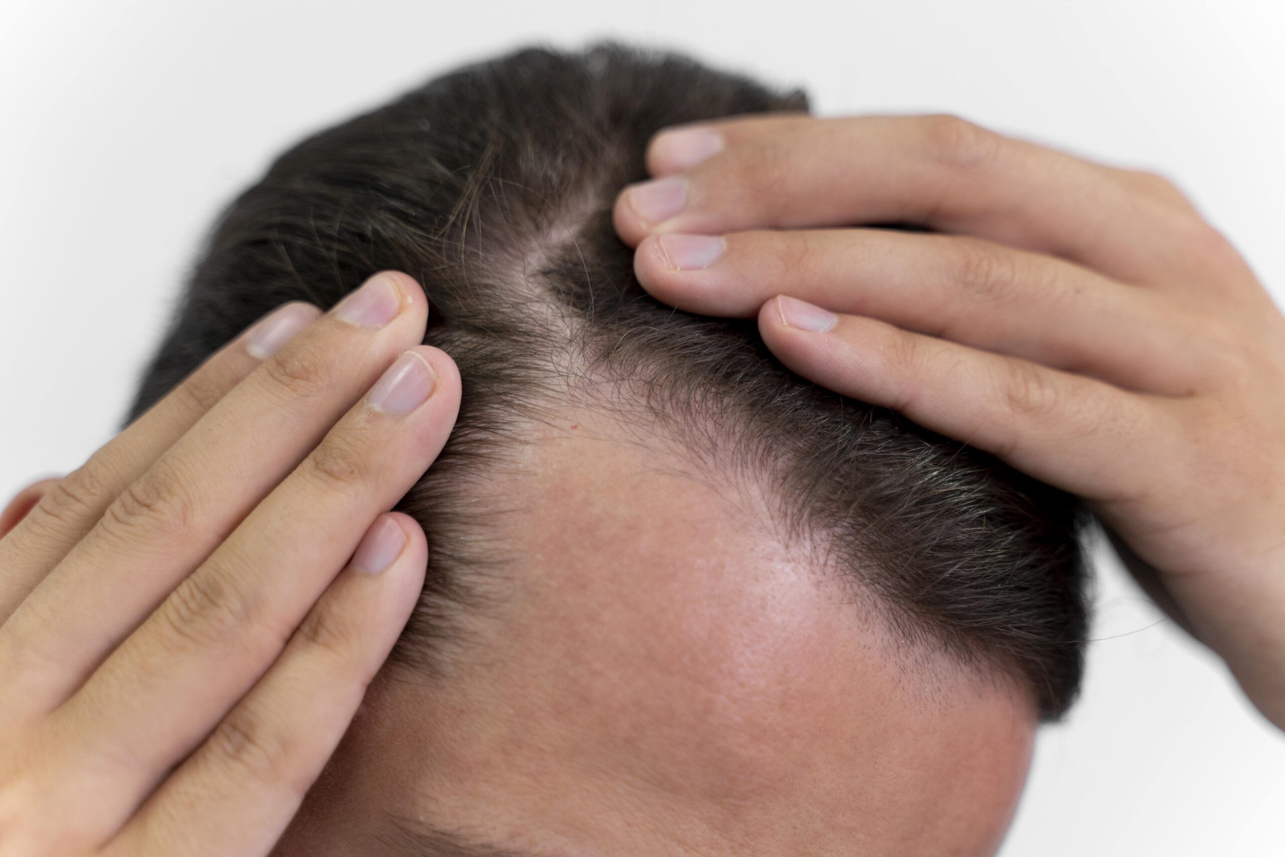 can-stress-cause-hair-loss