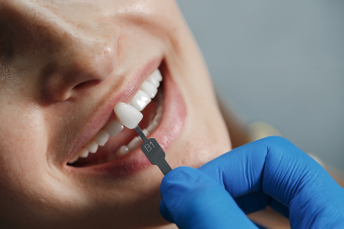 Zirconium-Dental-Veneer-Cost