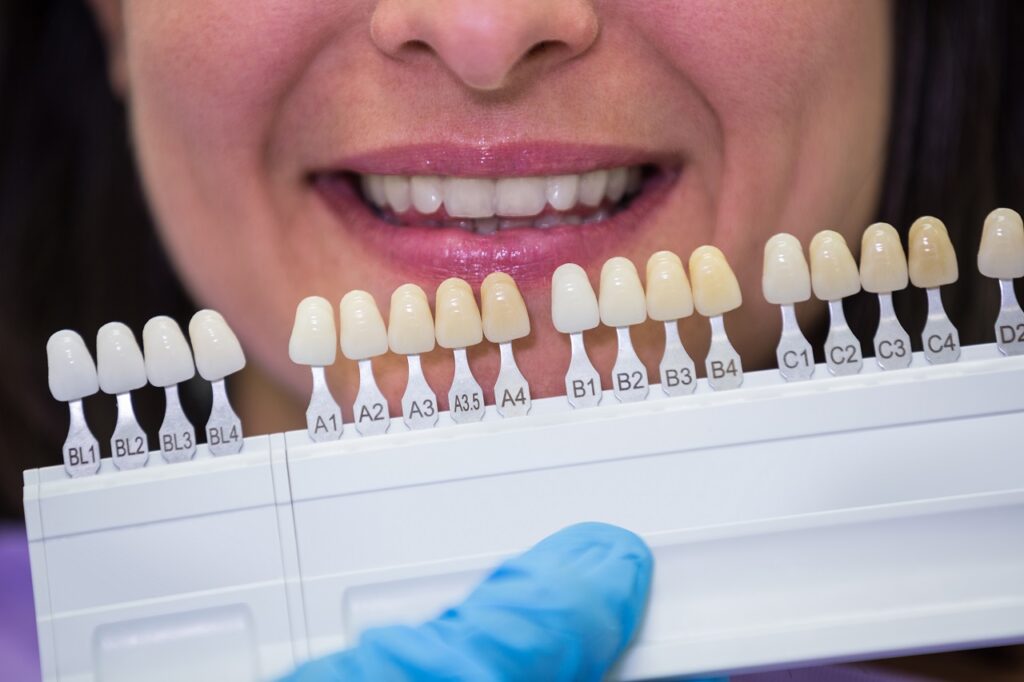 What is Emax Dental Veneers?