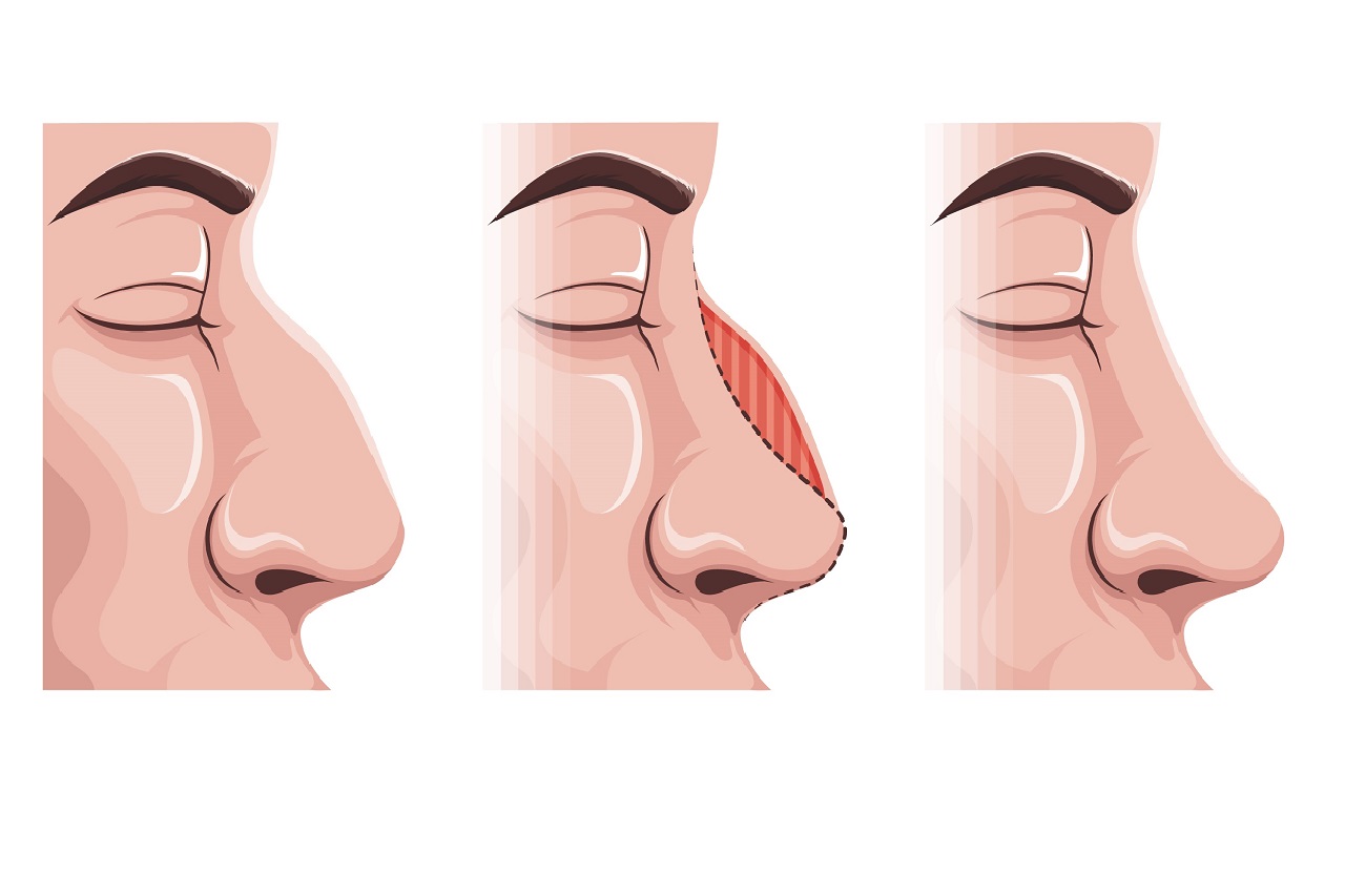 nose-type-chart