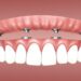 dental-implant-surgery