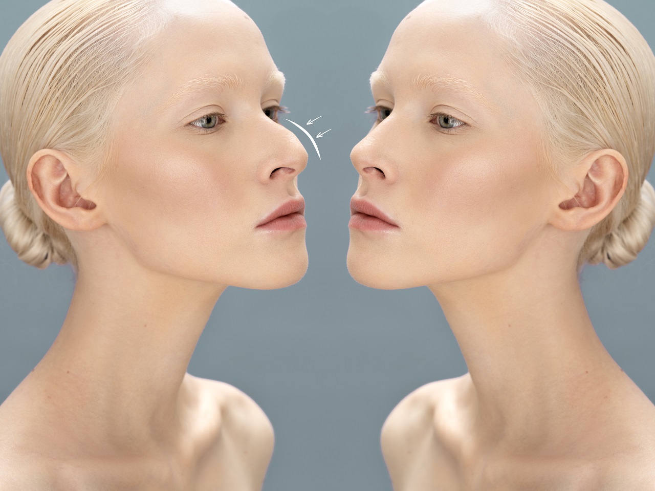 What is the Nose Job Age Limit? In Which Situations Is Nose Job Applied?