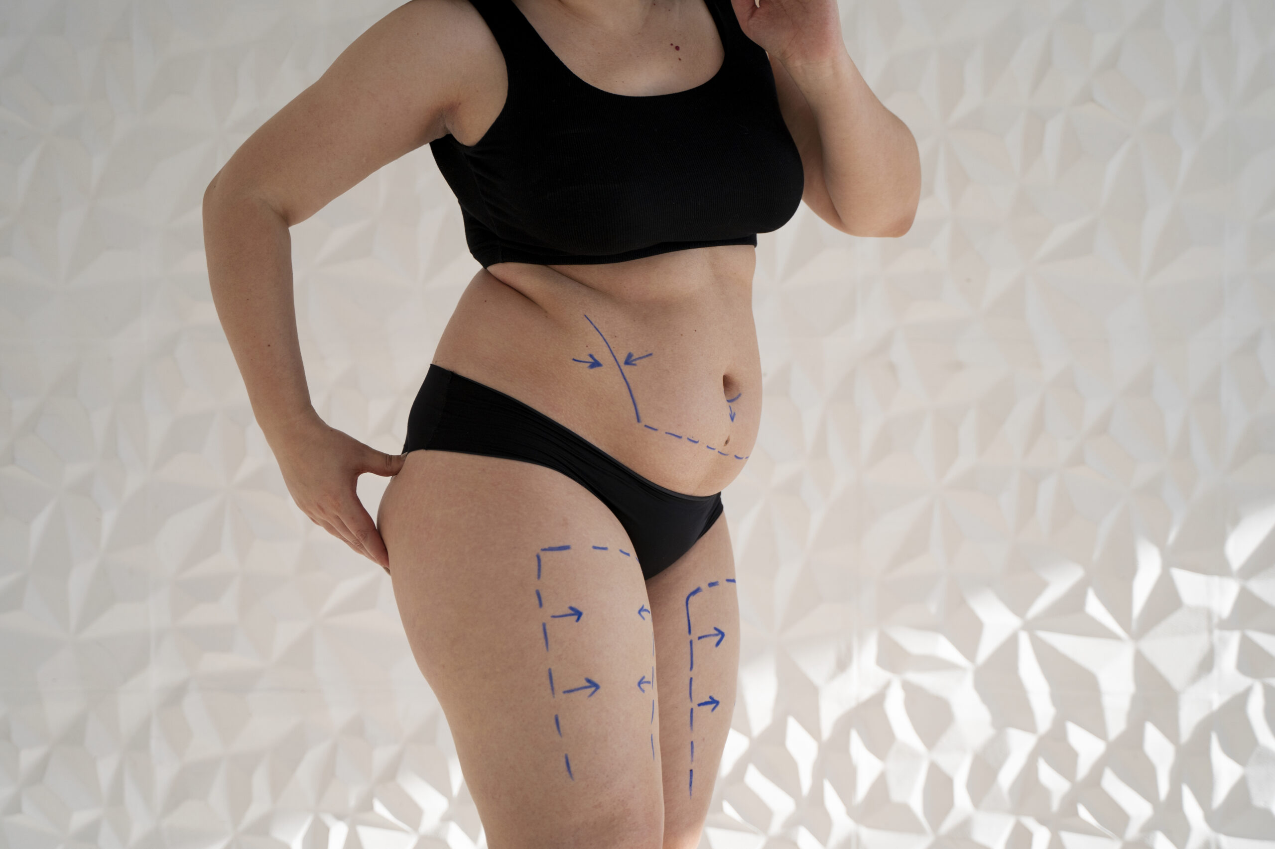 What are Tummy Tuck Complications? Tummy Tuck Side Effects and Healing Process