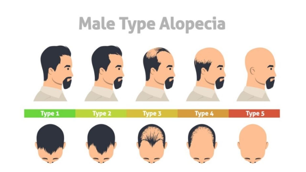 hair-transplant-growth-chart