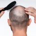 The Most Affordable FUE Hair Transplant Cost of the World