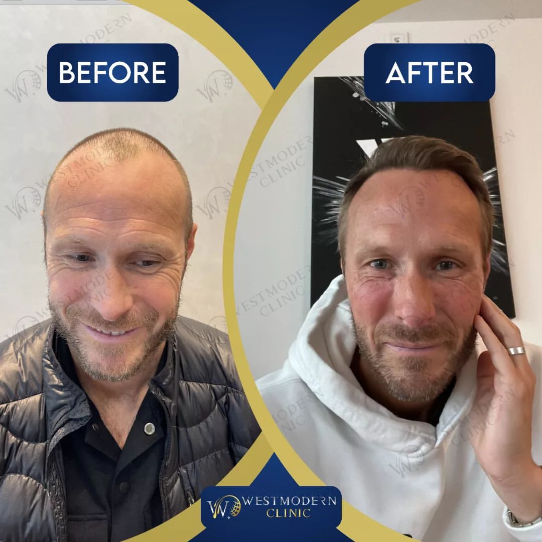 hair-transplant-turkey-before-and-after-