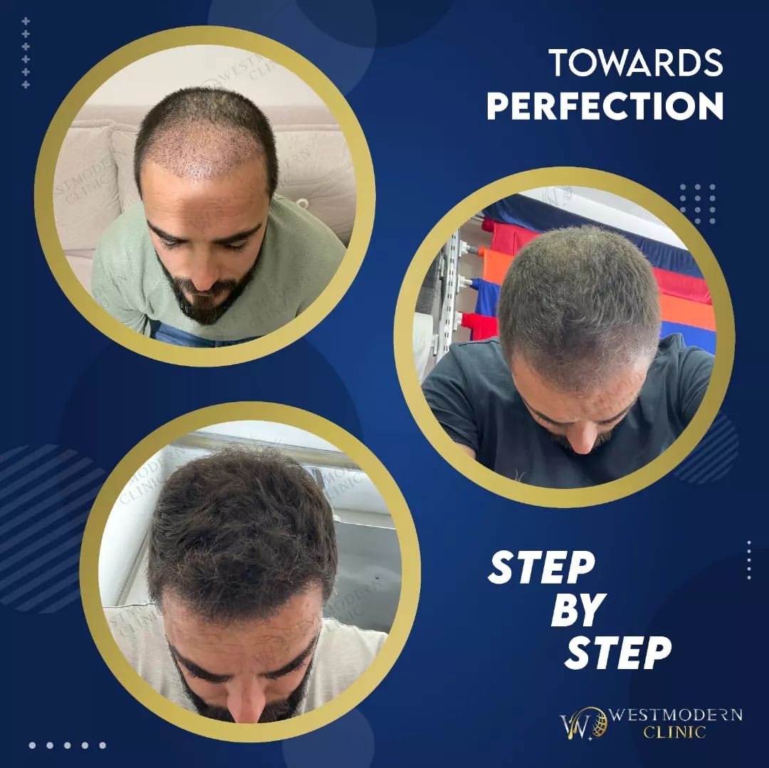 hair-transplant-turkey-before-and-after-