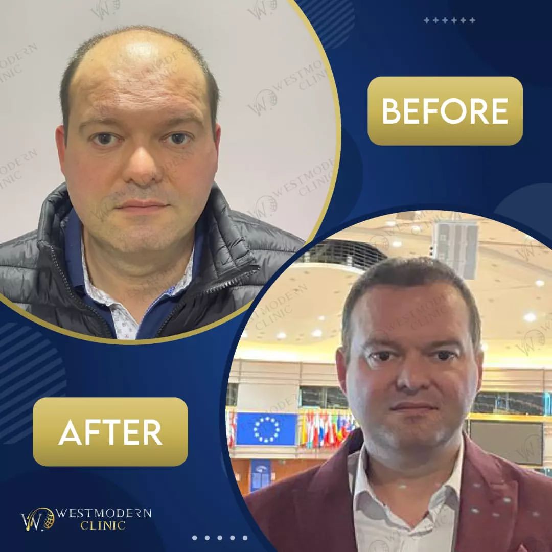 hair-transplant-turkey-before-and-after-