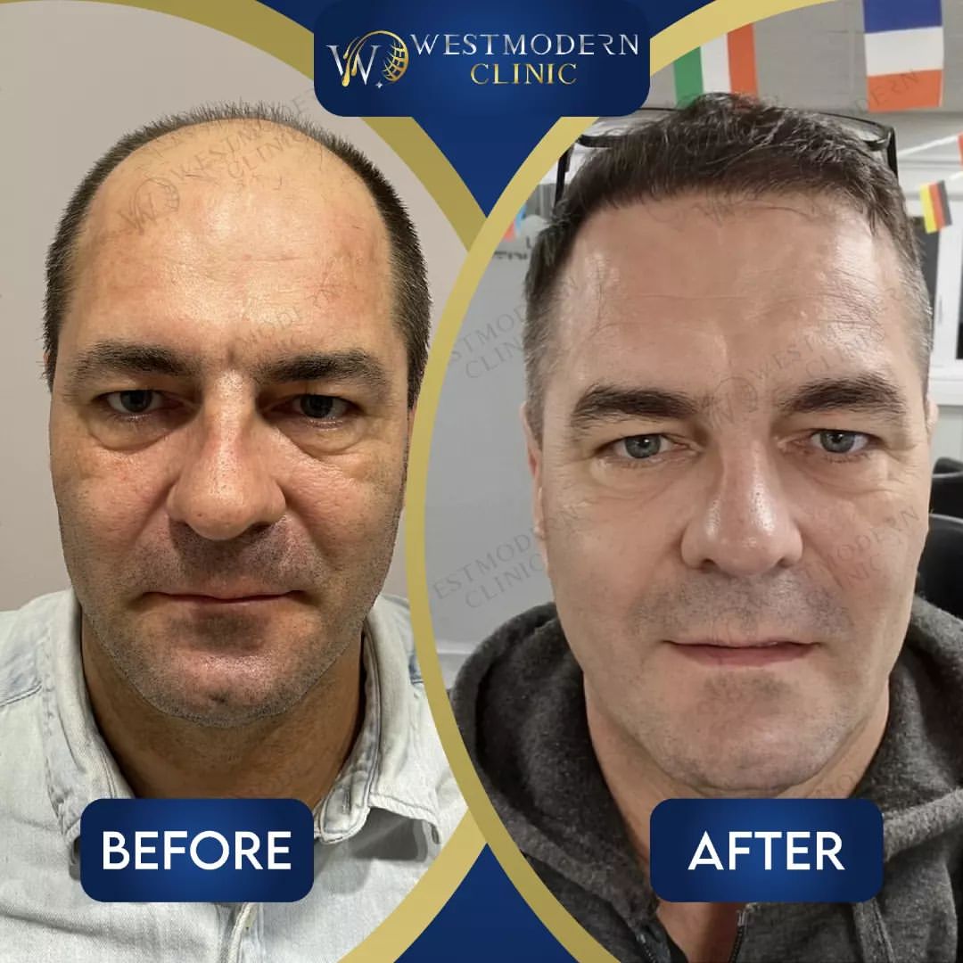 hair-transplant-turkey-before-and-after--5