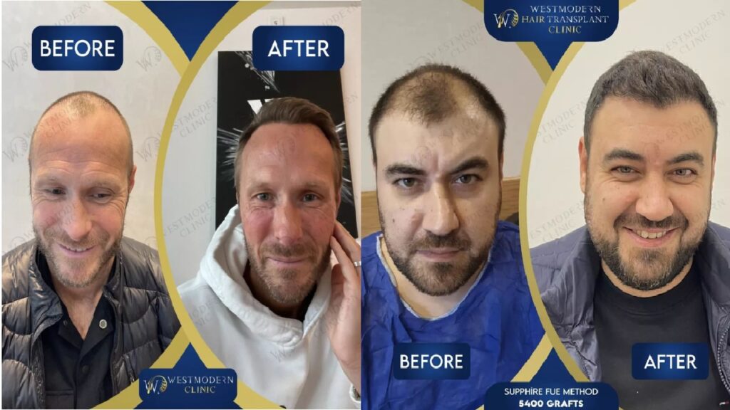 What Does Hair Transplant Growth Chart Look Like?