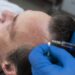 how-much-does-a-full-hair-transplant-cost-in-turkey