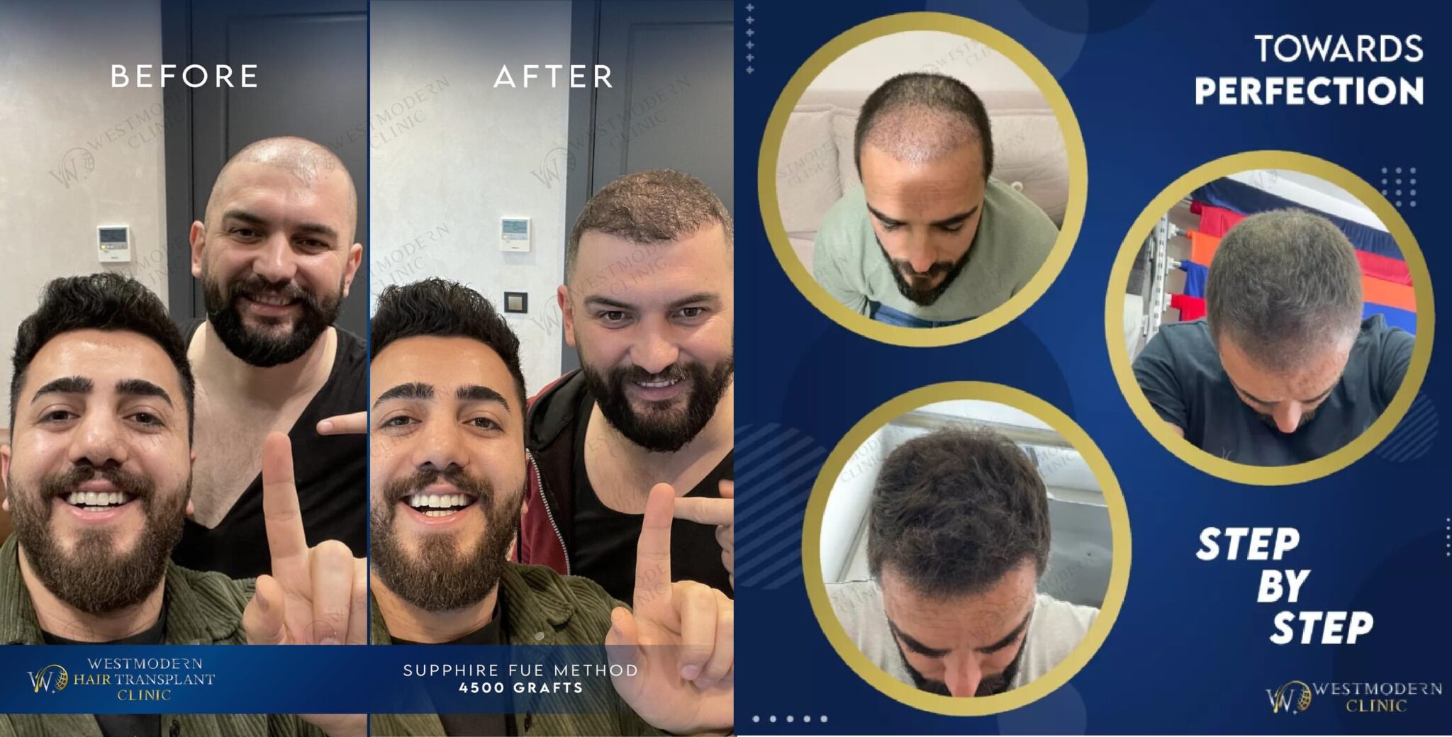 What Does Hair Transplant Growth Chart Look Like?