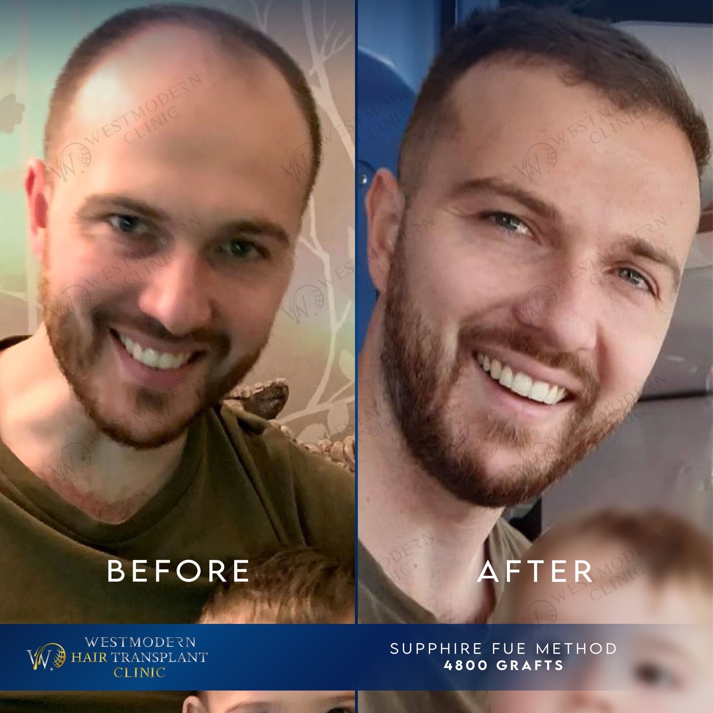 hybrid-hair-transplant-price