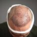 What Should You Expect from Your Turkey Hair Transplant Experience?