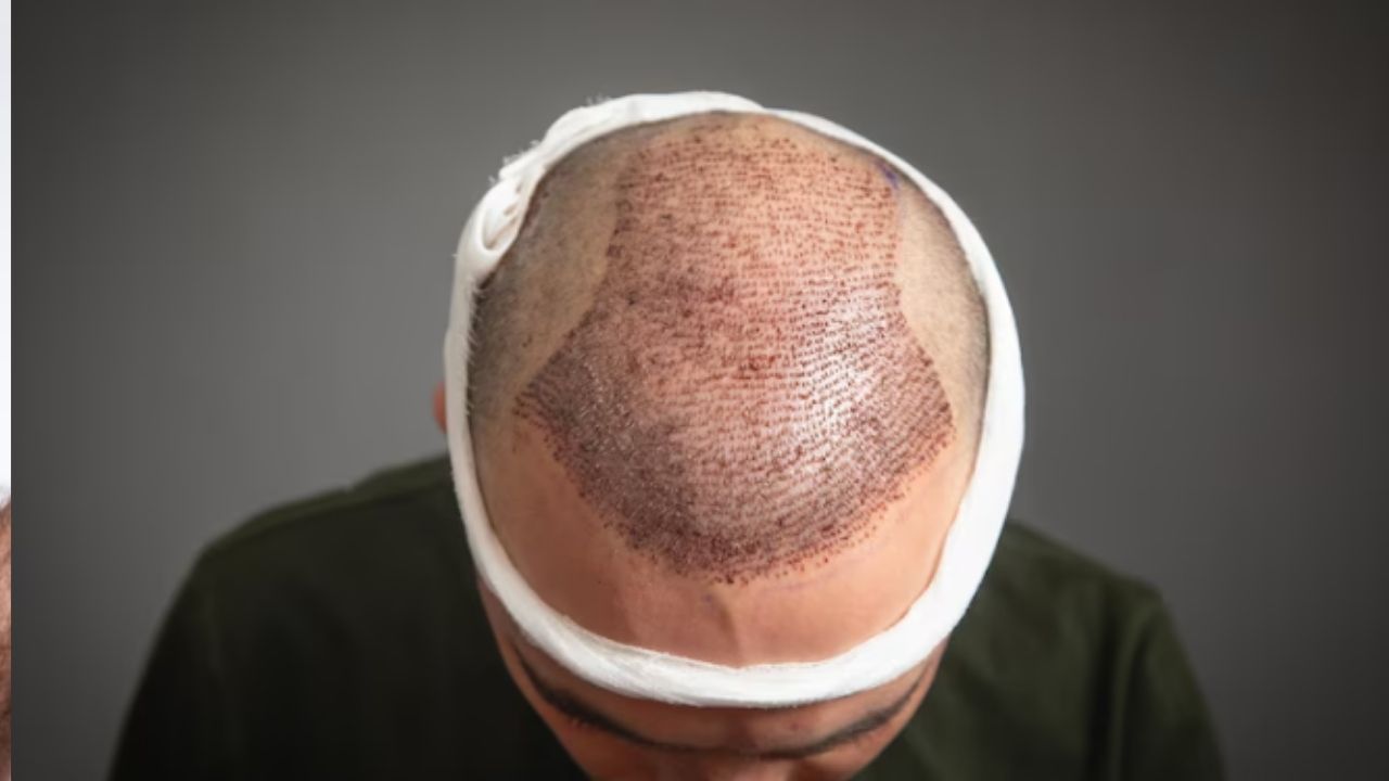 How Much is Turkey Hair Transplant Cost in Indian Rupees?